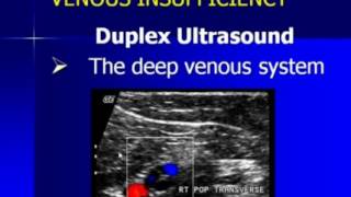 Lower Extremity Venous Duplex Ultrasound Chronic Venous Insufficiency [upl. by Krusche]