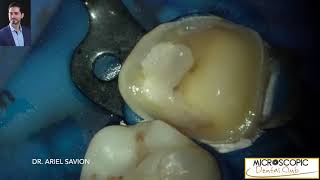 Expert Crown Cementation with Rubber Dam Precision and Efficiency by Dr Ariel Savion [upl. by Claresta]