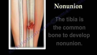 NONUNION OF FRACTURES CAUSES AND TREATMENT  Everything You Need To Know  Dr Nabil Ebraheim [upl. by Iot]