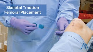 Skeletal Traction  Femoral Placement [upl. by Arenat]