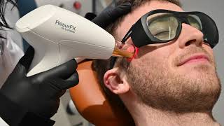 Acne Scar Treatment with Lumenis ResurFX Laser Resurfacing [upl. by Yovonnda420]