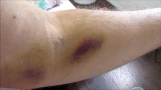 What to do When Donating Plasma so your arm doesnt look like this [upl. by Pearla]