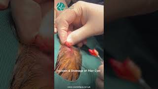 Incision amp Drainage of Pilar Cyst by Dr Azim Jahangir Khan at Cosmetique [upl. by Emaj]