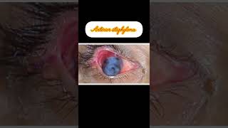 staphyloma structure type youtube viral videos [upl. by Letitia132]