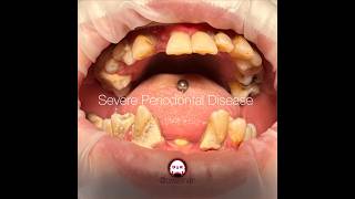 Severe Periodontal Disease with bone loss generalized inflammation and tissue edema [upl. by Yentruoc]