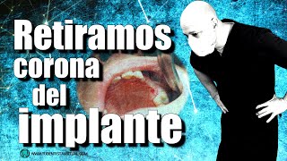 Como quitar una CORONA dental CEMENTADA de un IMPLANTE [upl. by Rocker951]