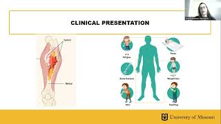 Osteosarcoma  Diagnosis Treatment and Research Advances [upl. by Niliram]