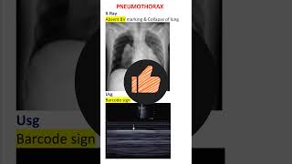 Pneumothorax Diagnosis Xray amp Usg Pearls NEET PG INICET [upl. by Norra]