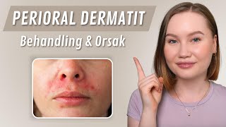 Bli av med Perioral Dermatit SNABBT [upl. by Aiepoissac]