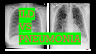 Chest Xray interstitial lung disease vs PneumoniaTypes of opacities in lungs [upl. by Annnora]