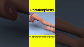 Rotationplasty surgery 3D video [upl. by Einna]