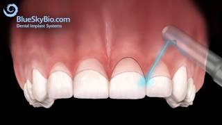 Patient Treatment Videos Gingivectomy [upl. by Ted336]