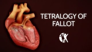 Tetralogy of Fallot  Cincinnati Childrens [upl. by Aerehs573]