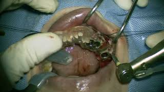 Straumann NC RN WN place in posterior mandible 2 [upl. by Ytsirk]