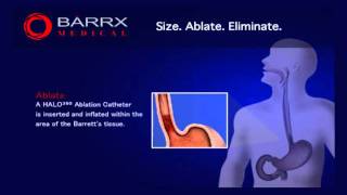 BARRX Medical HALO360 ablation technology [upl. by Cormier]