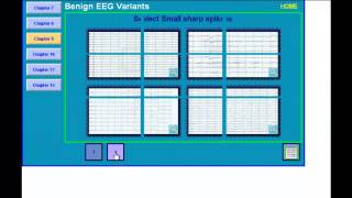 Benign EEG Variants [upl. by Latsyrhk]