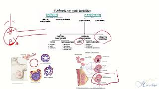 Pagets diseaseBreast tumors [upl. by Dill]