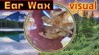 Ear wax removal amp Ear Cleaning （15） [upl. by Baxter]