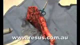 Surgical Airway on resuscomau [upl. by Kelci]