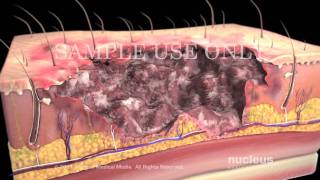 Burns Classification and Treatment [upl. by Ailelc]