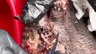 Jigger removal chigger removal sandflea removal satisfying cyst and boil popping compilation [upl. by Analaj]