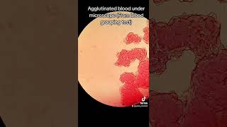 Agglutinated blood from blood grouping test under microscope [upl. by Lamphere]