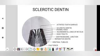 sclerotic dentin dental histologyDADH [upl. by Noswad]