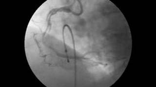 Spiral dissection of Right Coronary Artery [upl. by Keppel]