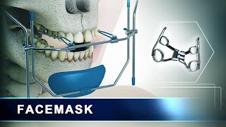 Facemask  Orthodontic Headgear Appliance  3d Animation [upl. by Ianteen]