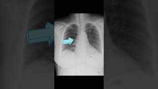 Fusiform aneurysmal dilatation of ascending aorta [upl. by Nilyam]