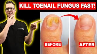 1 BEST Toenail Fungus Treatment Top 10 Home Remedies 2024 [upl. by Merralee]