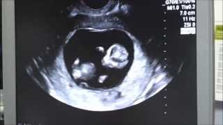 13 weeks ultrasound girl or boy [upl. by Eimme]