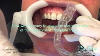 Starting Invisalign Treatment Placing Attachments and Fitting Tray 1 [upl. by Shaw]