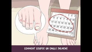 Comment couper un ongle incarné [upl. by Tnahsin]