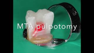 MTA pulpotomy step by step by Jorge Casián Adem [upl. by Shurlocke]