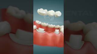 Use earphone Dental Bridge Porcelain Procedure after extraction satisfying [upl. by Magbie]