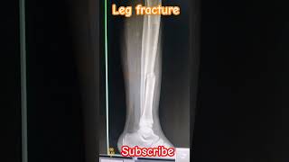 Left Leg 🦵 AP lateral view Xray shorts viral medical student trending craft me [upl. by Mide]