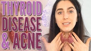 Thyroid Disease Versus Acne [upl. by Breger]