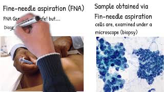 Needle Biopsy FNA is really safe  Cancer spreading risk You should be informed of the risk [upl. by Downe396]