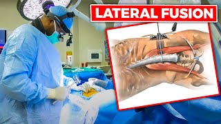 INSIDE THE OR Lateral Lumbar Interbody Fusion LLIF wpercutaneous screws [upl. by Blodgett]