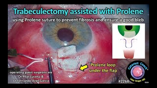 CataractCoach™ 2268 trabeculectomy assisted with Prolene suture [upl. by Ittocs]