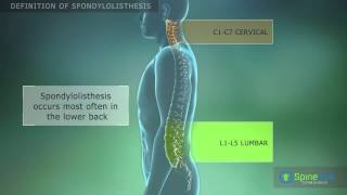 Spondylolisthesis Definition [upl. by Lindner]