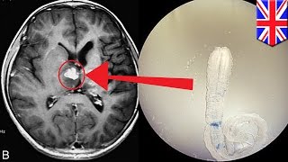 Tapeworm infection Rare brain worm took 4 years to crawl across UK man’s brain [upl. by Aliuqat]