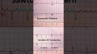 Atrial Flutter ECG [upl. by Fernald]