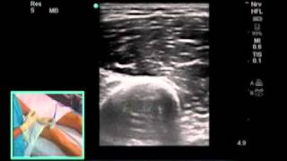 How to Ultrasound Guided Saphenous Nerve Block Scanning Technique [upl. by Hole92]