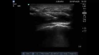 trochanteric bursitis injection [upl. by Tuchman]