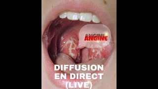 ANGINE QUESTIONS ET REPONSES Diffusion en direct  Dr Toure [upl. by Ardiedak]