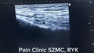 Genicular nerve block for knee joint pain [upl. by Ahtinak475]