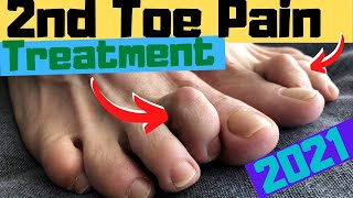 2nd Toe Capsulitis Claw Toe amp Hammer Toe RELIEF Taping amp Treatment [upl. by Kaete]