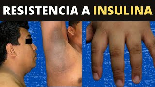 RESISTENCIA A LA INSULINA  ¿Qué le hace a tu cuerpo [upl. by Adolphus]